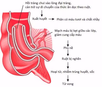 4 dấu hiệu chứng tỏ trẻ bị lồng ruột, cha mẹ cần lưu ý