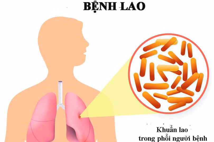 Các bệnh dễ nhầm với lao phổi