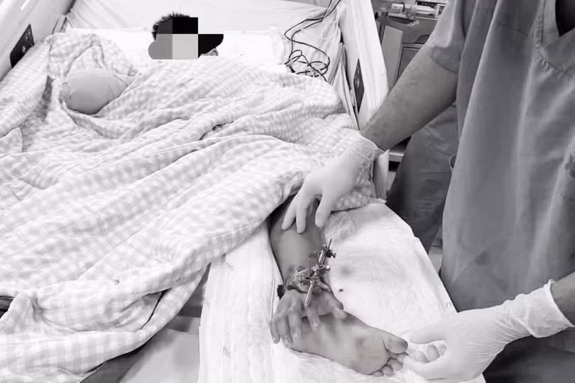 Ê-kíp phẫu thuật đã thực hiện kỹ thuật nối bàn tay vào hệ thống mạch máu ở cẳng chân để tạm thời duy trì sự sống. (Ảnh: người nhà cung cấp).