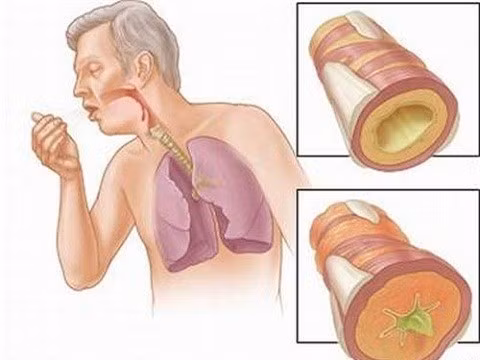nhung nguoi co nguy co mac ung thu phoi