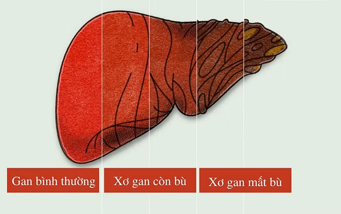 Mùa nóng làm gì để bảo vệ gan hiệu quả?