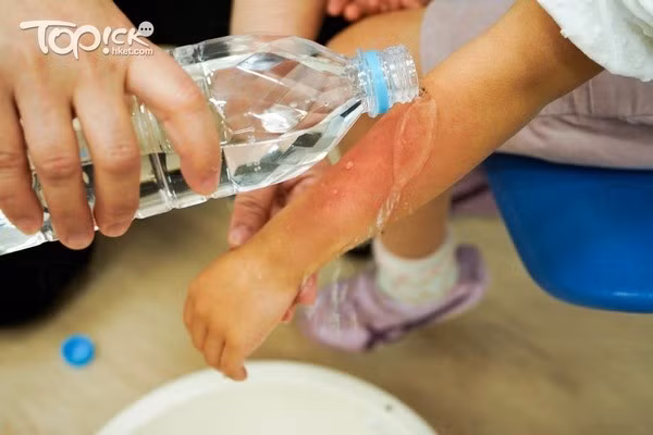 Đây là phương pháp sơ cứu vết bỏng chuẩn nhất cho trẻ nhỏ mà bố mẹ rất nên nhớ