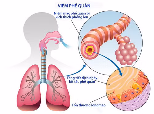 Phòng ngừa bệnh đường hô hấp dễ mắc trong mùa nóng