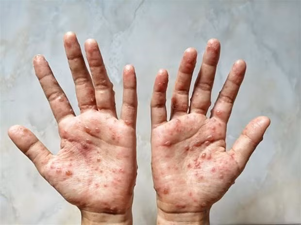 WHO ban bố tình trạng khẩn cấp y tế toàn cầu đối với bệnh đậu mùa khỉ
