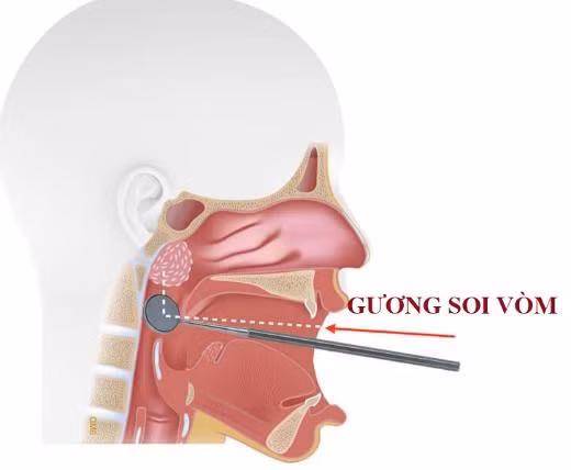 Phát hiện sớm ung thư vòm mũi họng
