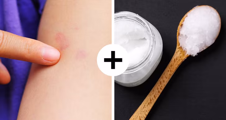11 mẹo sơ cứu ban đầu bạn nên biết