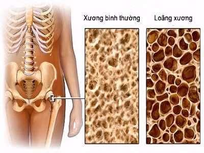 Các nhóm bệnh đe dọa sức khỏe người cao tuổi